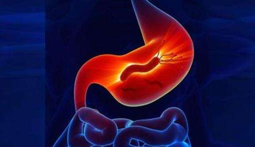 JGH OPEN：阿司匹林对胃癌的发生和生存的影响