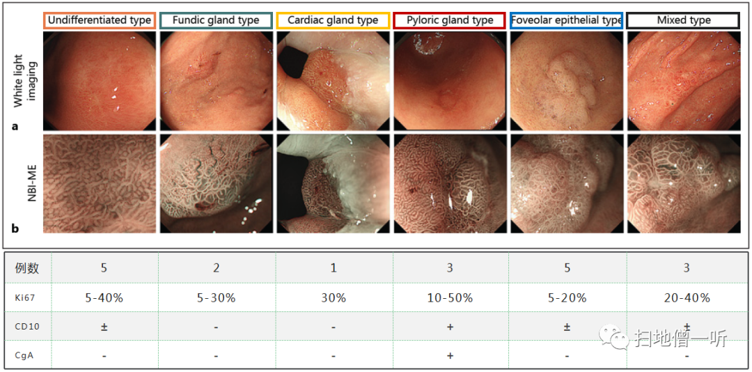 盘点幽门螺杆菌阴性早期胃癌的6种类型