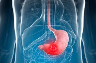 Gastric Cancer：单纯手术足以治疗具有广泛淋巴结转移的T1胃癌