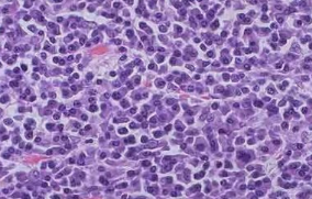 NEJM：达拉他单抗联合来那度<font color="red">胺</font>和地塞米松治疗不适合自体干细胞移植的骨髓瘤