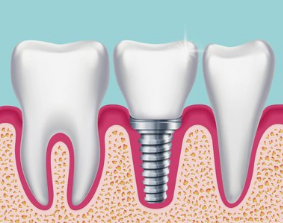 Clin Implant Dent Relat Res：有或没有自体块状<font color="red">移植物</font>的颗粒状异种<font color="red">骨</font>替代物引导<font color="red">骨</font>再生的效果
