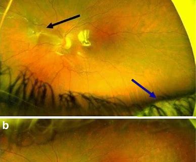 FDA授予大麻素PPP003（HU308）预防增生性玻璃体视网膜病变的孤儿药称号