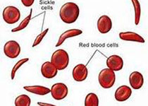 Blood：镰状细胞病和β-地中海<font color="red">贫血</font>胎儿血红蛋白诱导表达的异质性<font color="red">机制</font>