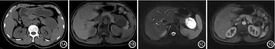 病例丨胰腺神经鞘瘤影像学特征剖析
