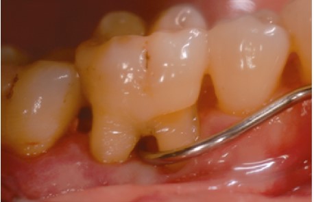 J Clin Periodontol：<font color="red">口腔</font>磁共振成像评估上颌磨牙根分叉病变的准确性