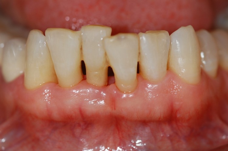 J Periodontol：<font color="red">上颌</font>前牙牙龈退缩与颊侧牙槽<font color="red">骨</font>厚度的关系