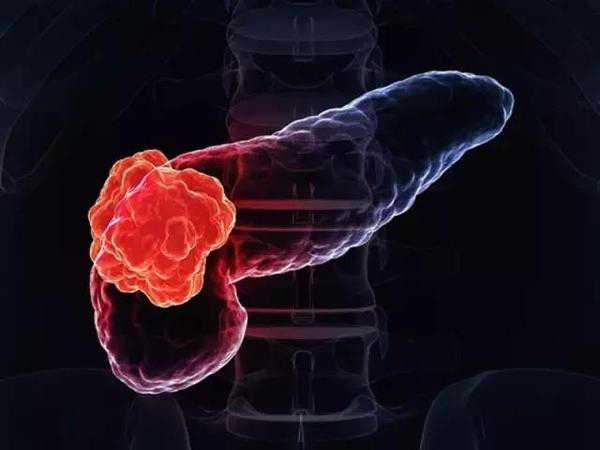 Dig Liver Dis： 他汀类药物可改善胰腺导管腺癌患者的生存率 