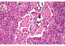 Cell Death Dis：E2F1介导<font color="red">DDX11</font>转录激活通过PI3K/AKT/mTOR通路促进肝细胞癌发生发展