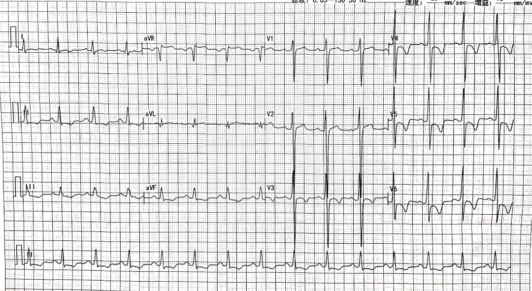 ST-T改变、T波倒置就是心肌缺血冠心病吗？