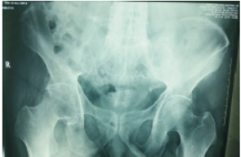 强直性脊柱炎病人超声引导下腰硬联合麻醉一例