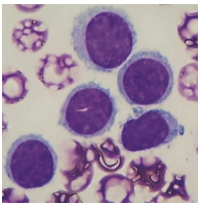 BCR-ABL1阳性变异型<font color="red">毛细胞</font>白血病1例