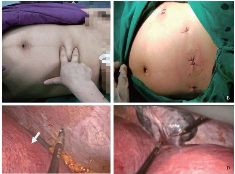 妊娠晚期卵巢囊肿蒂扭转经腹腔镜手术１例