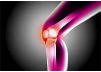 Arthritis Rheumatol：洛瑞文特治疗膝关节骨关节炎的2期随机试验