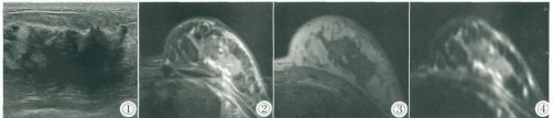 肺腺癌乳腺转移超声及MRI表现1例