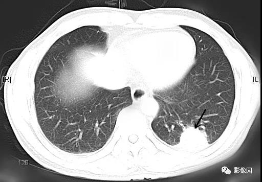 肺炎性肌纤维母细胞瘤2例