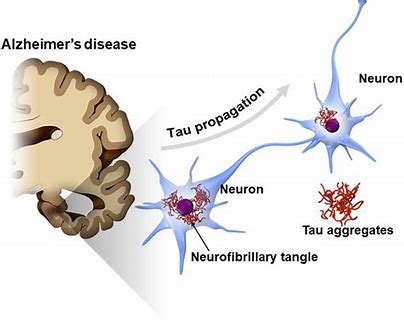 FDA批准Tau放射性诊断剂Tauvid用于阿尔茨海默症
