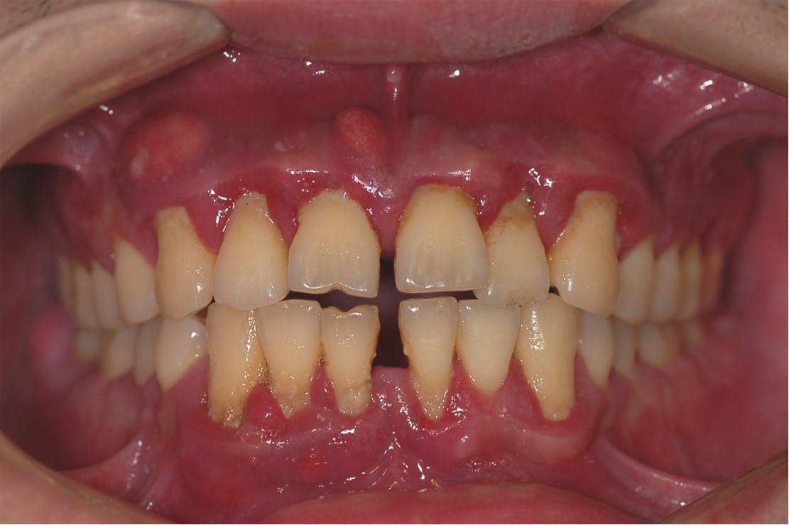 J Periodontol：全口消毒对重度牙周炎患者龈沟液中的钙蛋白、骨钙蛋白和Ⅰ型胶原交联氨基末端肽的影响