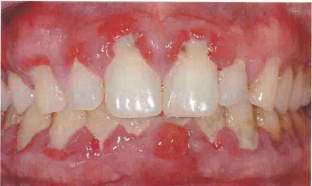 J Periodontol：牙周病中炎症小体调节转录的差异性表达