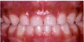 J Clin Periodontol：Flemish儿童乳磨牙的<font color="red">牙</font>槽骨水平