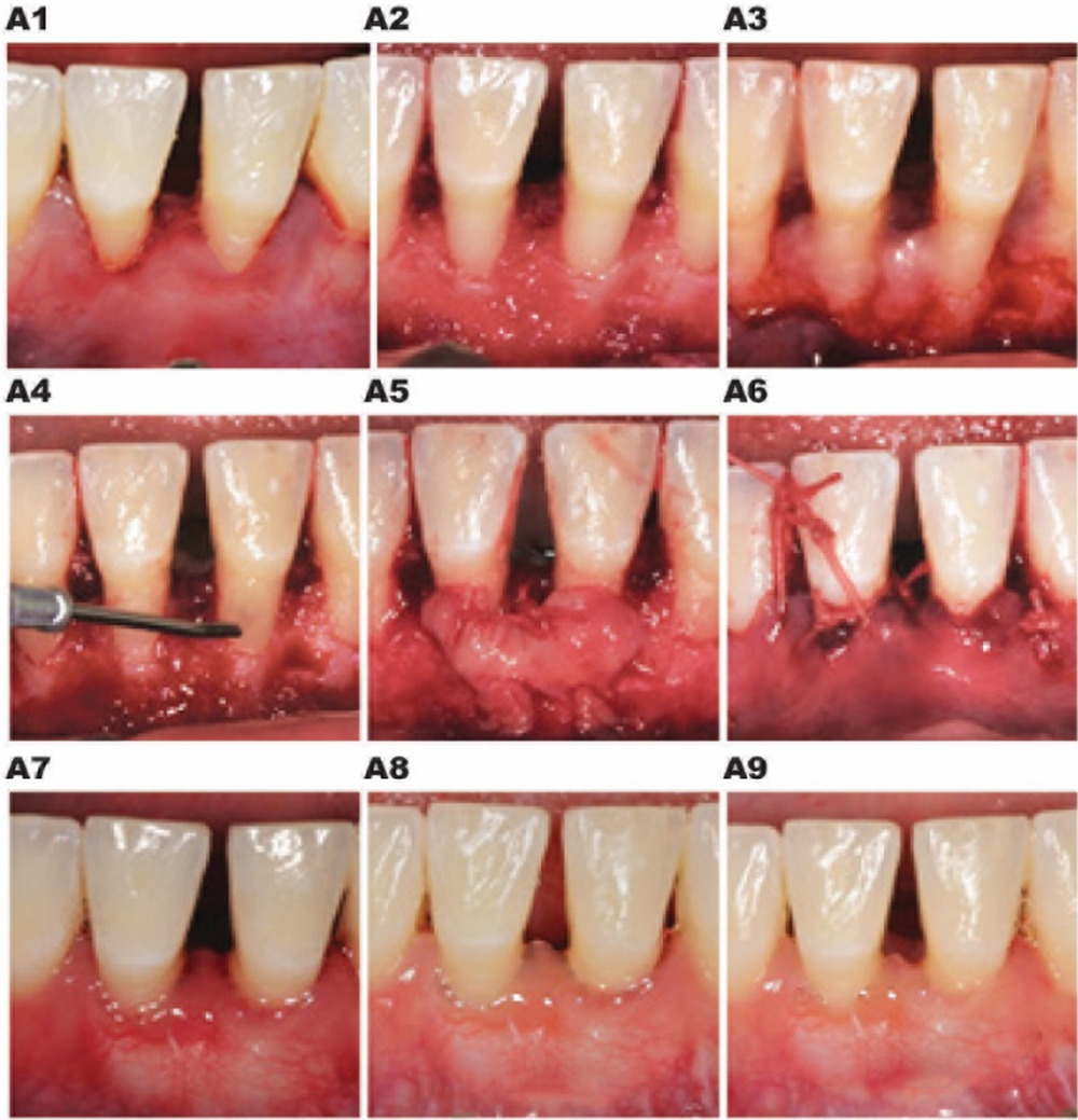 J Peiodontol：釉基质蛋白辅助上皮下结缔组织移植治疗下前牙III-IV级<font color="red">牙龈</font>退缩