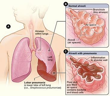 RECARBRIO（亚胺培南、西司他丁和雷巴坦）或能“力克”呼吸机相关细菌性肺炎