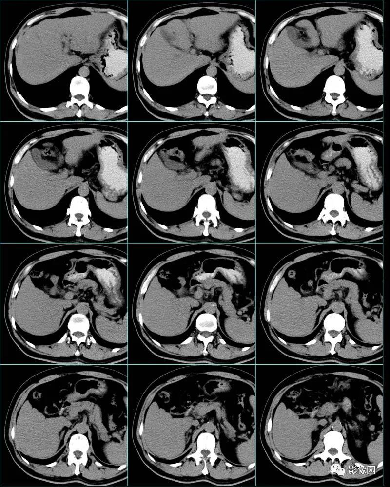 中年女性 头晕2年 头痛呕吐1月 请诊断 Medsci