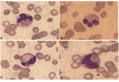 阵发性冷性血红蛋白尿患者<font color="red">外周血</font><font color="red">涂片</font>中性粒细胞、单核细胞吞噬红细胞现象１例