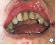 EGFR-TKIs药物相关口腔炎病例报告