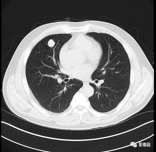 男性，体检发现右肺占位性病变21天，请诊断！