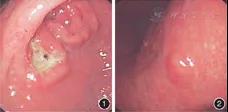 病例报告丨罕见的胃腺癌合并倒置性增生性息肉一例