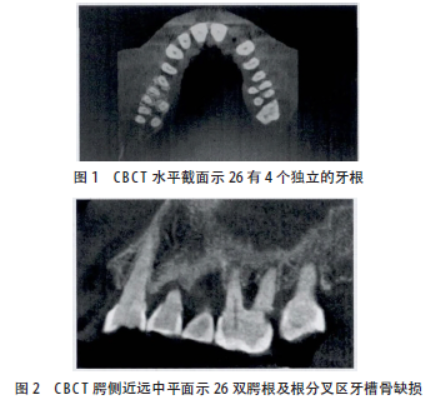 <font color="red">CBCT</font>辅助诊断上颌第一磨牙罕见双腭根1例