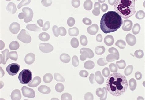 关注罕见病“真性红细胞增多症”：PTG-300获美国FDA孤儿药物认定