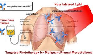 近红外光免疫疗法（<font color="red">NIR-PIT</font>）：治疗恶性胸膜间皮瘤的曙光