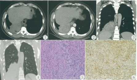 原发性肺滑膜肉瘤1例
