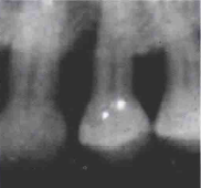 J Clin Periodontol：引导性组织再生治疗深牙周骨缺损26年后的牙齿存活率和临床效果评价