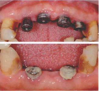 J Clin Periodontol：<font color="red">漱口水</font>辅助机械清创治疗种植体周围粘膜炎