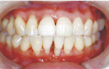 J Periodontal Res：广泛型牙周炎免疫应答相关基因的DNA甲基化谱