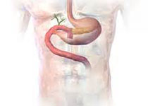 Gastroenterology：胆汁酸螯合剂IW-3718辅助治疗难治性胃食管反流病