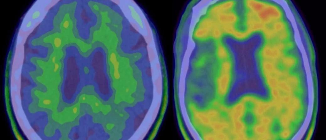 JAMA Neurol：揪出阿尔茨海默症的“元凶”，这一基因驱动大脑淀粉样蛋白<font color="red">斑块</font>首次出现