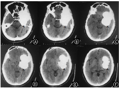 砂粒体型脑膜瘤一例