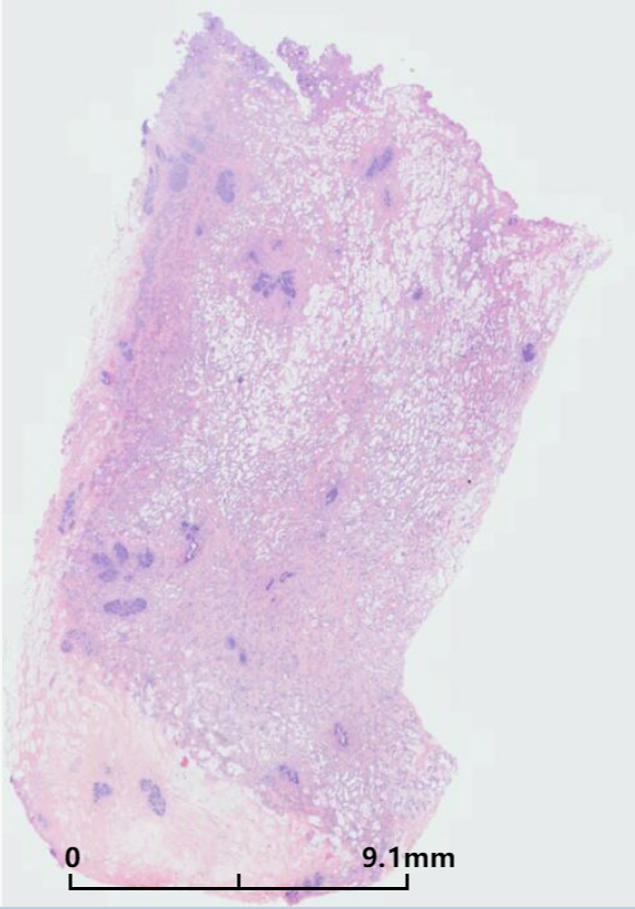 乳房巨大纤维腺瘤1例