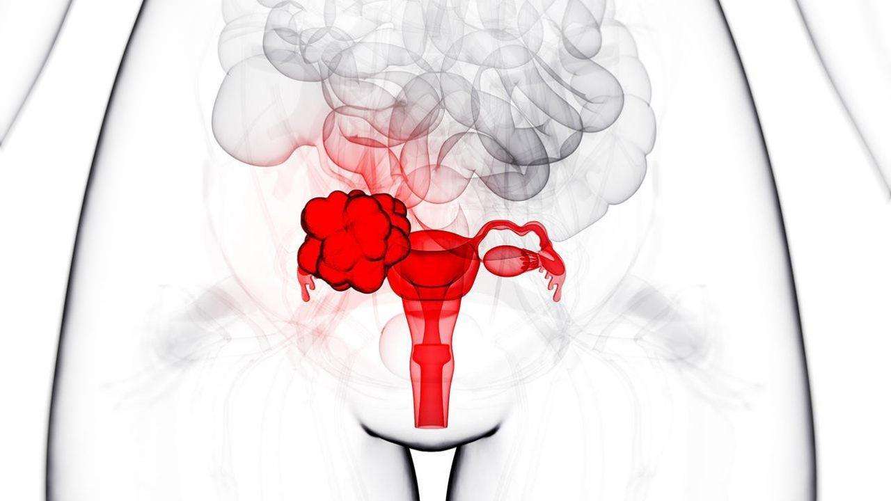 Lancet oncol：<font color="red">ARIEL</font>3试验：Rucaparib维持治疗铂敏感性复发性卵巢癌超过2年后的探索性分析