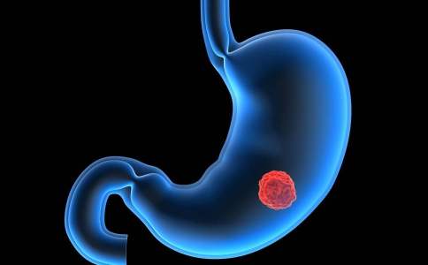 Lancet oncol：Margetuximab联合派姆单抗治疗HER2+的胃食管腺癌