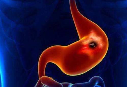 Gastric Cancer: 炎症和营养标志物在胃癌新辅助化疗加D2淋巴结清扫术患者生存预测中的临床价值及应用
