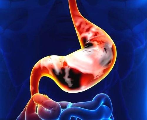 Gastric Cancer: 糖尿病与胃癌的风险增加有关