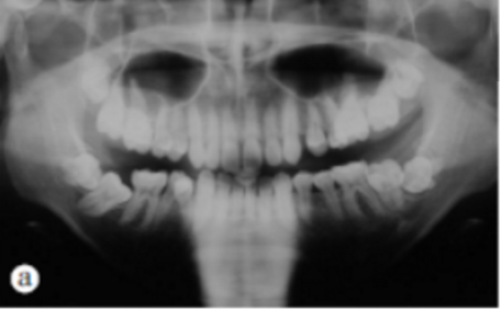 遗传性牙龈纤维瘤病牙周-正畸联合治疗1例