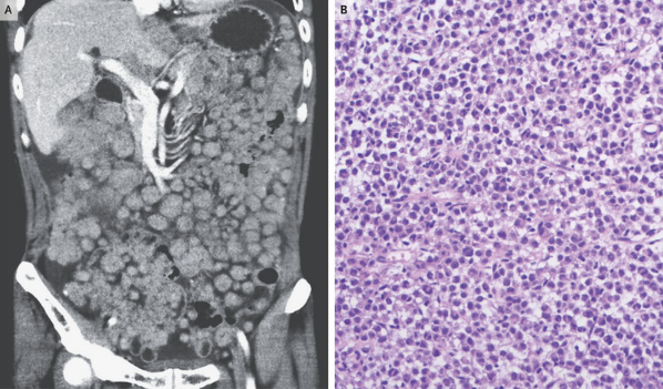 NEJM：转移性透明细胞肉瘤-病例报道