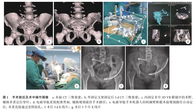 虚拟现实技术联合电磁导航手术机器人辅助治疗复杂骨盆骨折一例