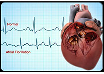 JAHA：心率<font color="red">变异</font>性指数可预测房颤患者的心血管死亡率