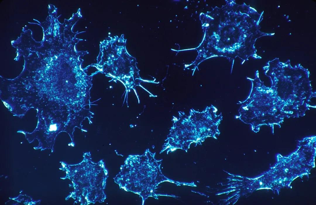 Sci Adv：癌细胞为了转移长出“手指”！高侵袭性肺癌前导细胞“手指”更长
